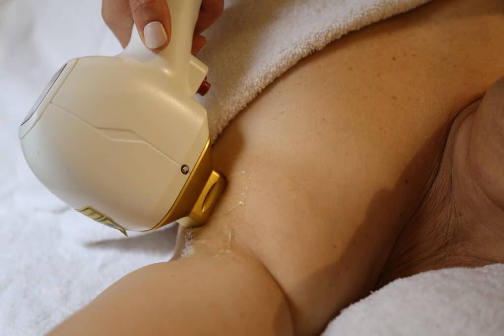 Epilation laser femme